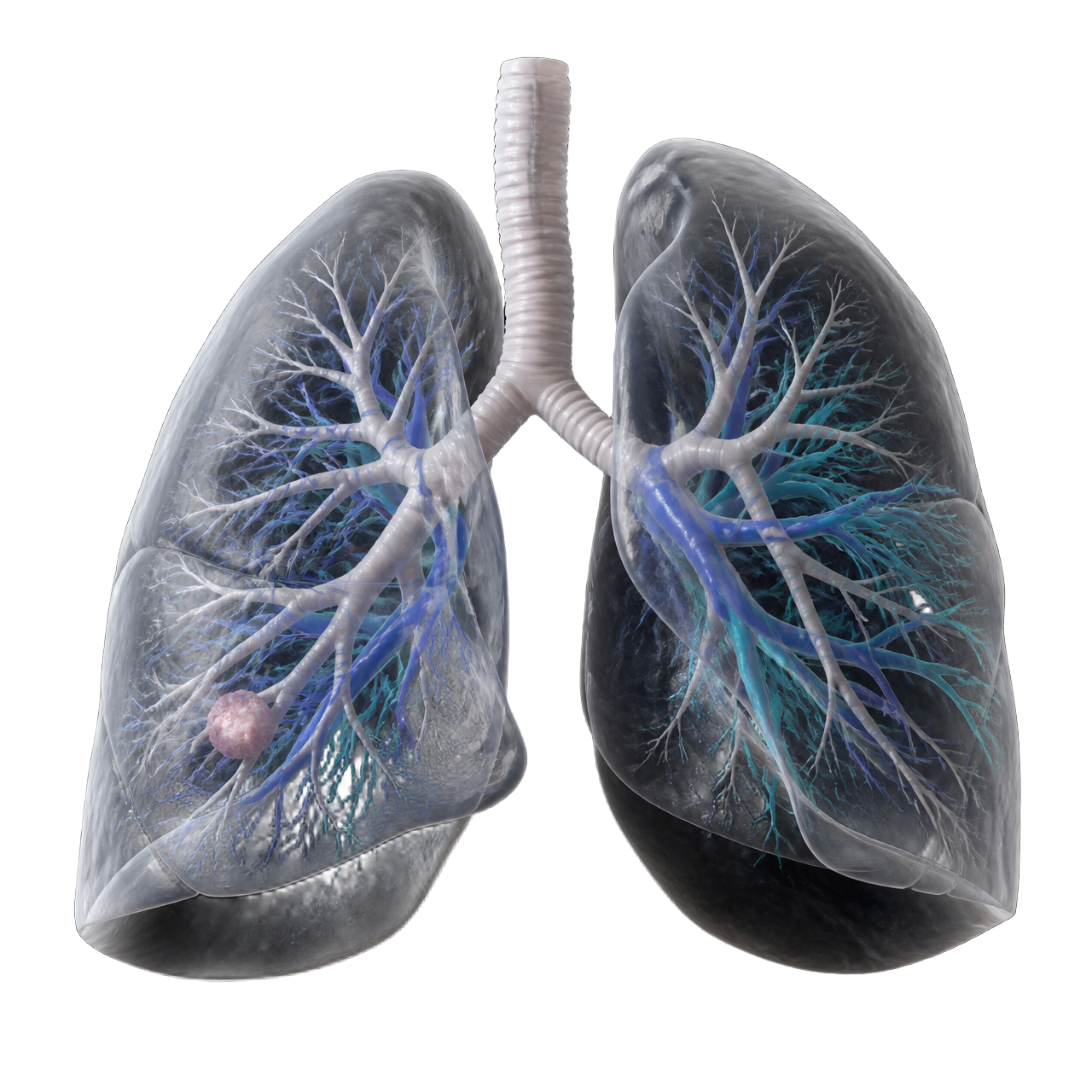 3D lung reconstruction showing bronchial tree, pulmonary arteries and veins with a lesion