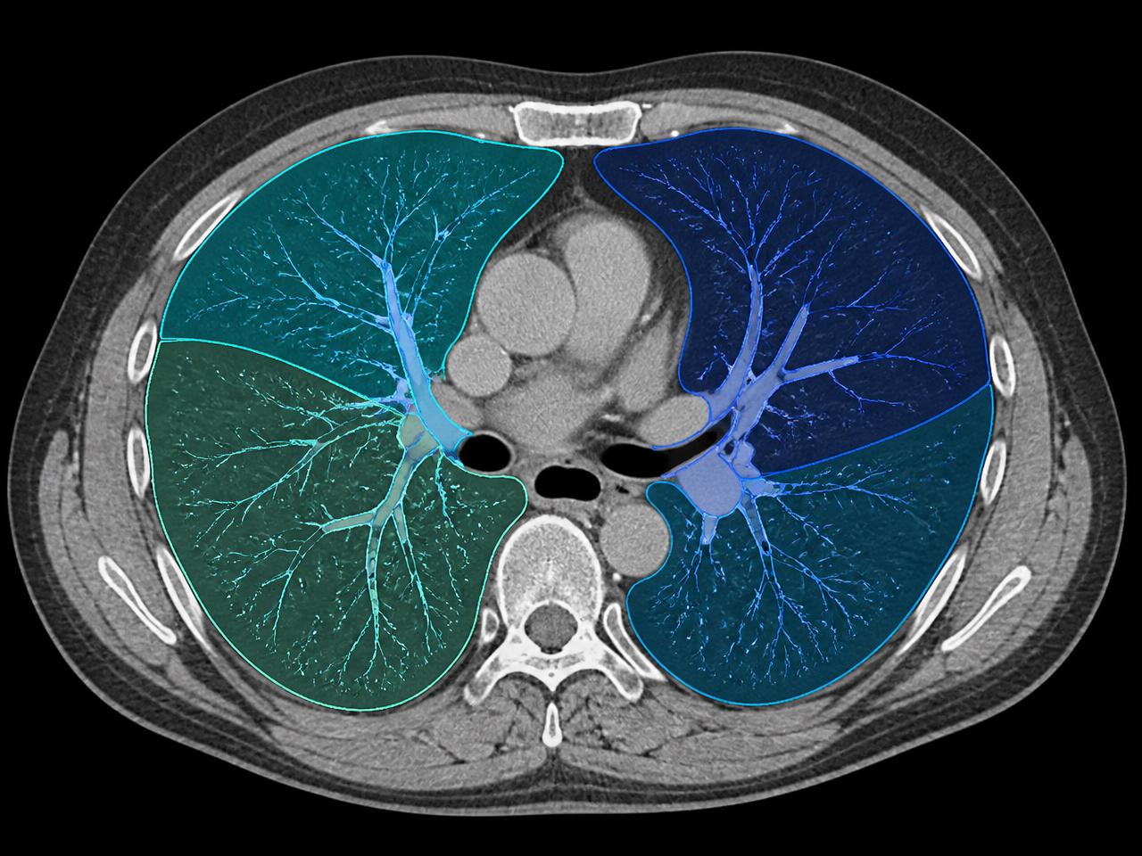 CT slice with AI segmentation overlays of lung lobes and vessels